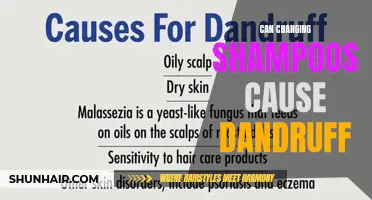 Dandruff Dilemma: Can Switching Shampoos Trigger Flaky Scalp?