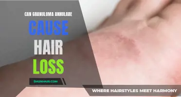 Understanding the Connection Between Granuloma Annulare and Hair Loss