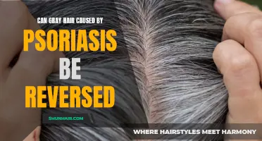 Can Gray Hair Caused by Psoriasis Be Reversed?
