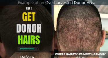 Uncover the Answers: Can I Get Donor Hairs to Solve Hair Loss?