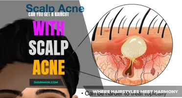 Dealing with Scalp Acne: Can You Still Get a Haircut?