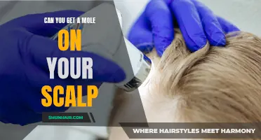 Understanding Moles: Can You Develop a Mole on Your Scalp?