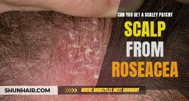 Understanding the Link Between Rosacea and Scalp Issues: Is a Scaly, Patchy Scalp Possible?