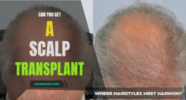 Exploring the Viability of a Scalp Transplant: Can You Regain Hair Through Transplant Surgery?