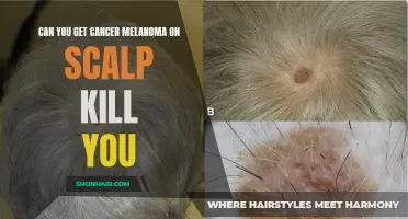 Can Melanoma on the Scalp Be Deadly?