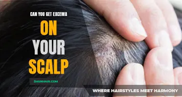 Understanding Eczema: Can It Affect Your Scalp?