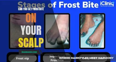 Understanding the Risks: Can You Get Frostbite on Your Scalp?