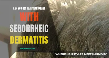 Understanding Hair Transplantation Options for Individuals with Seborrheic Dermatitis