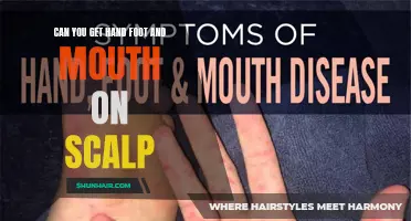 Understanding the Risks: Can Hand, Foot, and Mouth Disease Affect the Scalp?