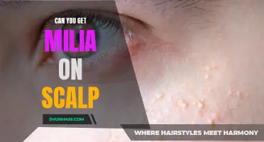 Understanding Milia: Can You Develop These Small White Bumps on Your Scalp?