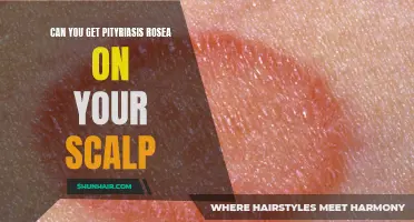 Understanding Pityriasis Rosea: Can the Scalp be Affected?