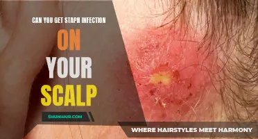 Understanding Staph Infection on the Scalp: Causes, Symptoms, and Treatment