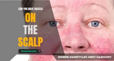 Can You Develop Rosacea on the Scalp?