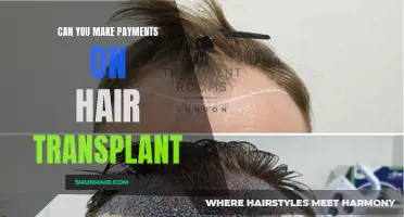 Ways to Make Payments on Hair Transplant: Exploring Your Options