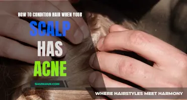 How to Care for Your Hair When Dealing with Scalp Acne