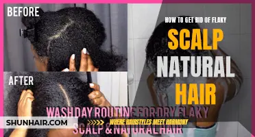 Natural Remedies for Getting Rid of Flaky Scalp on Natural Hair