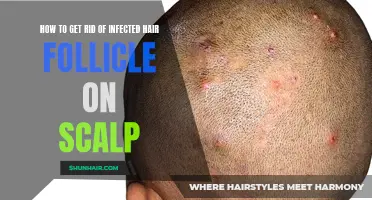 Effective Ways to Treat Infected Hair Follicles on the Scalp