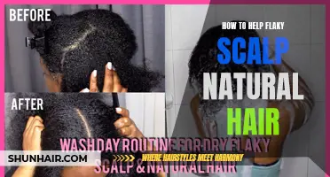 Effective Ways to Treat Flaky Scalp on Natural Hair