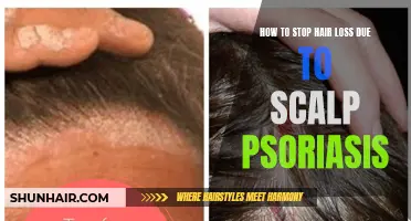 Effective Ways to Prevent Hair Loss Caused by Scalp Psoriasis
