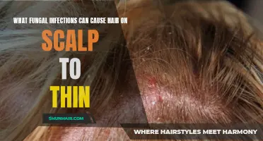 Understanding the Fungal Infections that May Lead to Thinning Hair on the Scalp