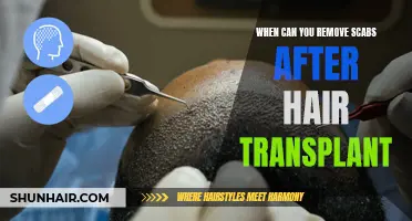 How Long Should You Wait Before Removing Scabs After Hair Transplant?